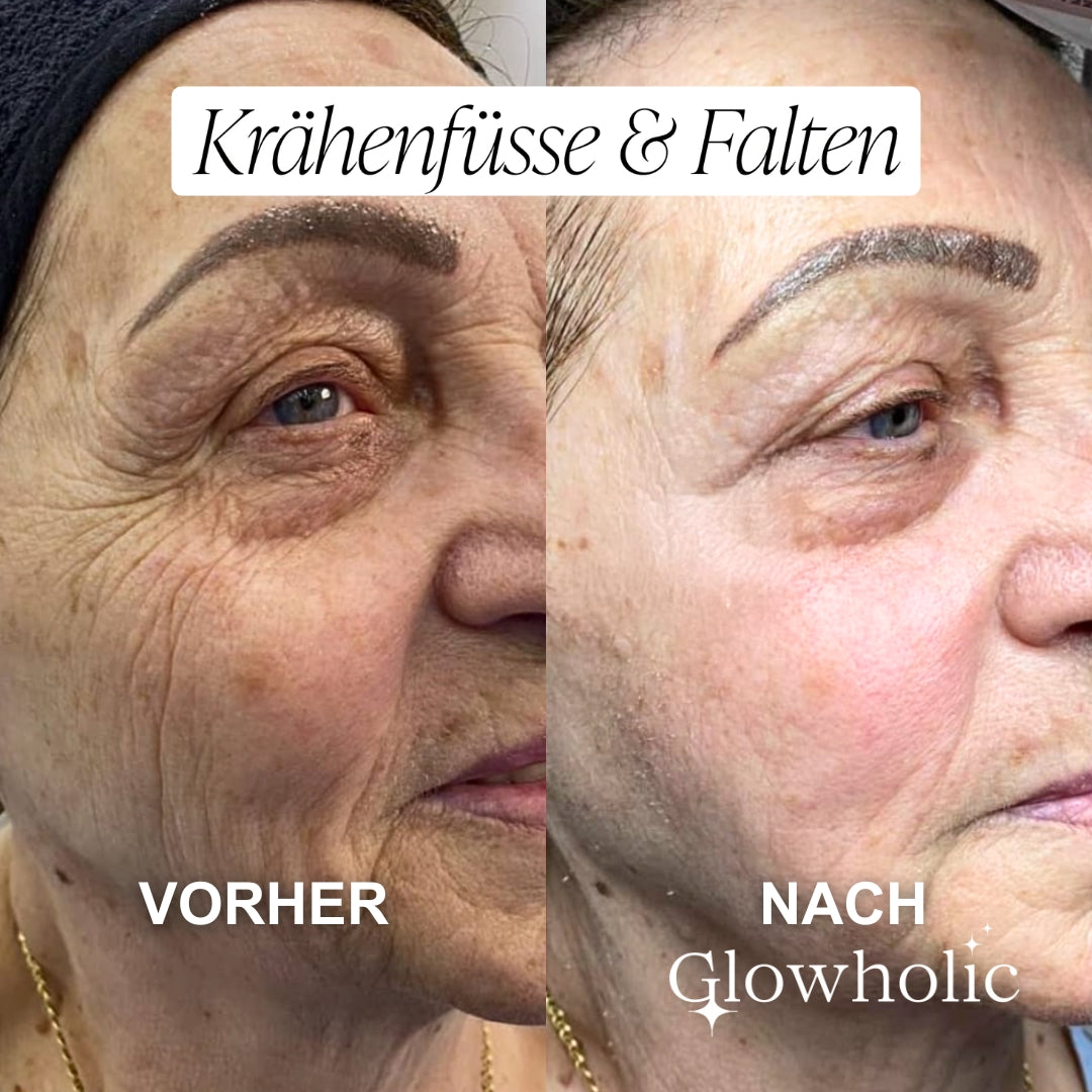 Glowholic Sommer Anti-Falten Starter Set - Micro-Needling-Infusion